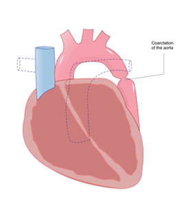 Aortic Coarctation