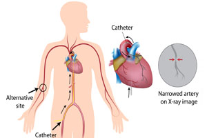 Keyhole Procedure
