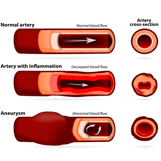 Normal Coronary Artery
