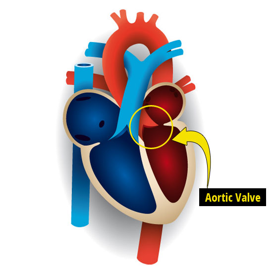 Aortic Stenosis