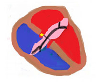 Intermediate AVSD
